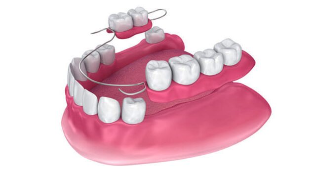 Yarım Damak Diş Modelleri