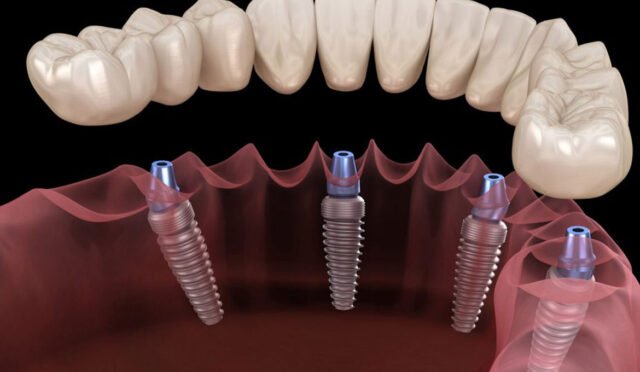 Devlet Hastanesinde İmplant Yaptıranların Yorumları